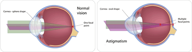 Astigmatism Correction