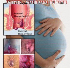 Obat wasir Herbal Hpai