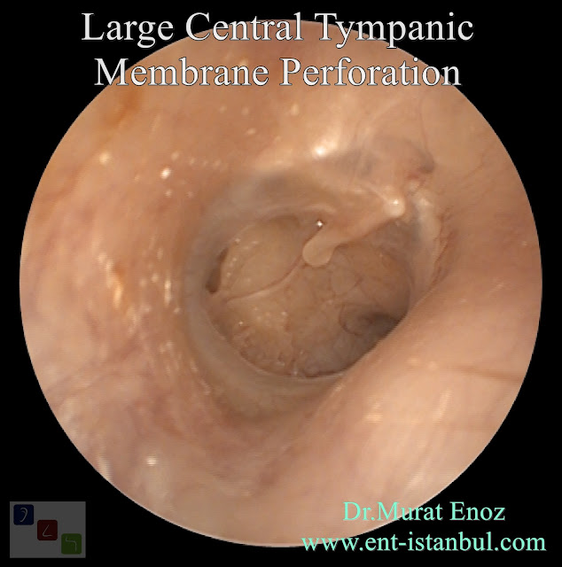 Large Central Tympanic  Membrane Perforation