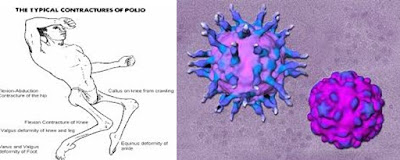 Virus Polio