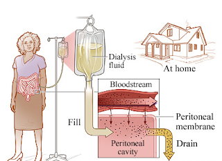 Quanto tempo si può nefropatia diabetica pazienti vivono dopo la dialisi