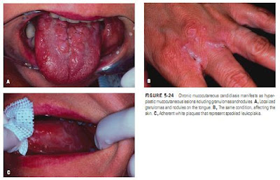 IMMUNOCOMPROMISED (HIV)-ASSOCIATED CANDIDIASIS