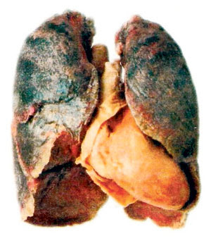 Risiko kanser perokok pasif