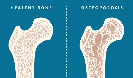 Osteoporotic Bone