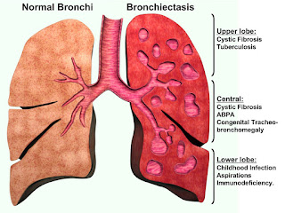 Bronchiectasis,bronchiectasis symptoms,bronchiectasis treatment