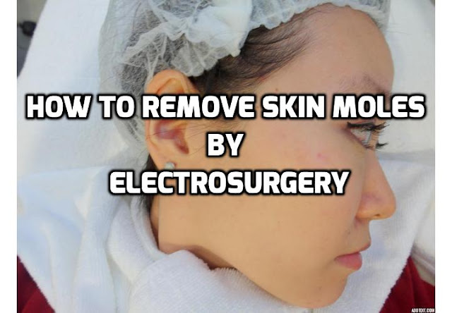 Electrosurgery or electrocautery is a surgical procedure that can be used to remove skin moles. The process involves the application of an instrument heated by an electric current on the area in consideration. Read on here to find out more about this skin moles treatment procedure.