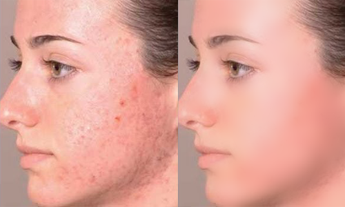 Acne Treatment Is All About Maintenance and Healthy Living