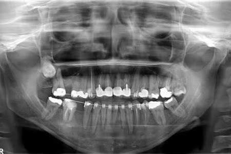 تعرفوا على : أشعة بانوراما الأسنان 