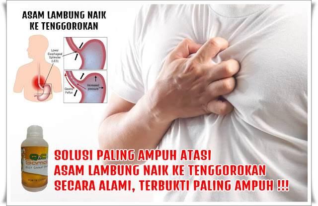 Cara Mengatasi Asam Lambung Naik