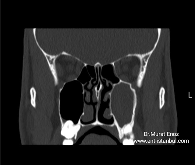 Chronic left maxillary sinusitis Tomography