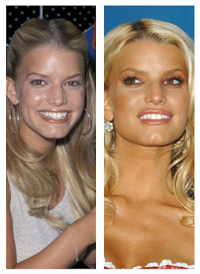 Jessica Simpson Plastic Surgery