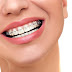 Có cần nhổ răng khi niềng răng hô vẫu nhẹ?