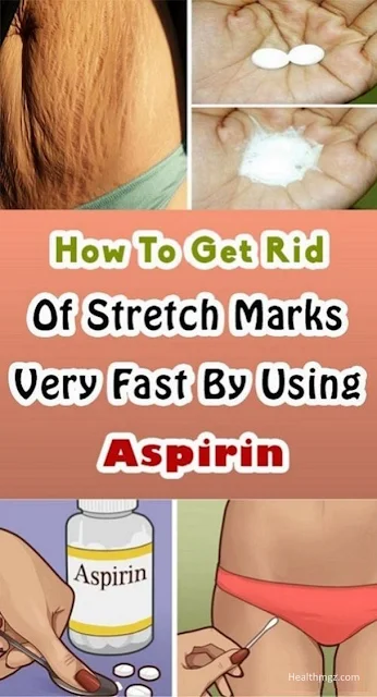 How To Get Rid Of Stretch Marks Very Fast By Using Aspirin!