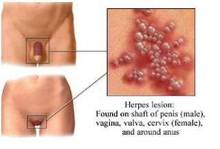 Is There Treatment For Herpes : The Cold Sore Remedy