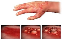 skin disease in hand