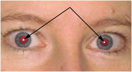 Red Eye Areas
