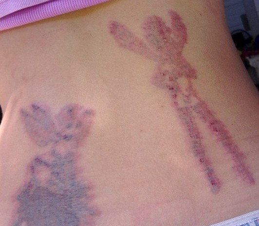My tattoo removal process: Day 2: Healing nicely the day ...