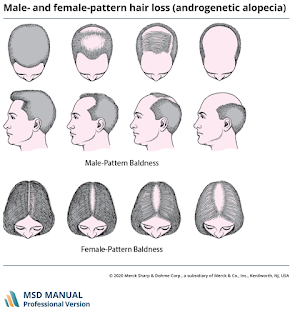 Male and Female Pattern Hair Loss