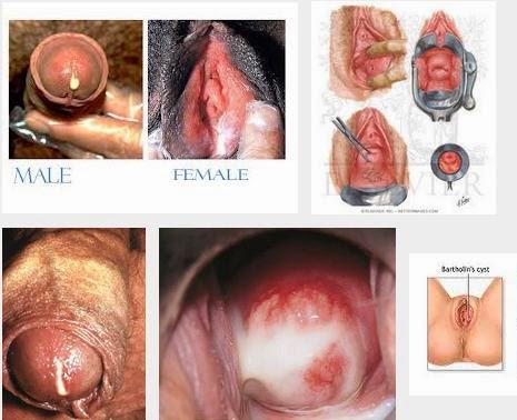 Hasil gambar untuk penyakit kelamin keluar nanah