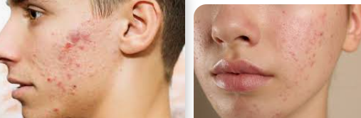 Best Korean Skincare Routine Steps for Hormonal Acne, Secret Revailed.
