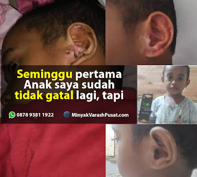 Minyak Varash Classic untuk Gatal di telinga Anak