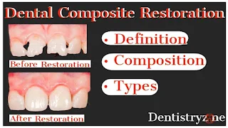 Dental Composite Restoration: Composition, Classification and Uses | Dentistry