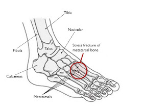 metatarsal-stress-fracture