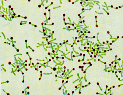 হোমিওপ্যাথিক ঔষধ ডিপথেরিনাম (Diphtherinum) [ ডিপথে - Diph ] এর লক্ষণ ব্যবহার উপকারিতা ক্ষতিকর উপসর্গ রিমেডি রিলেশন কিনোটস।।