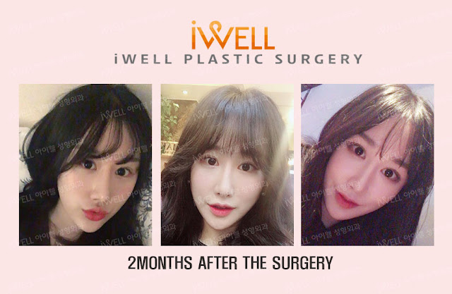 Double Eyelid Surgery in Korea
