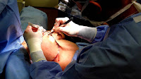 Pictures Of Breast Lifts Without Implants