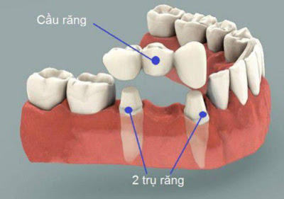 Trồng răng giả cố định có ảnh hưởng như thế nào ?