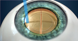 bladeless cataract surgery