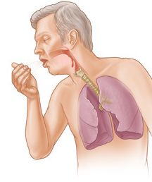 penyakit bronkitis