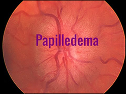 Papilledema