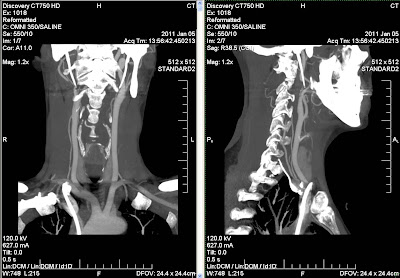 CT scan of head and neck arteries and veins