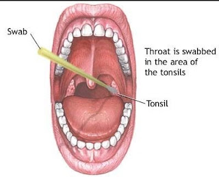First Signs Of Throat Cancer Pictures3