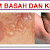 Obat Gatal Eksim Basah Ampuh