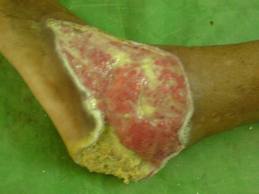 Kencing Manis & Diabetes: Gambar kaki luka kerana penyakit 