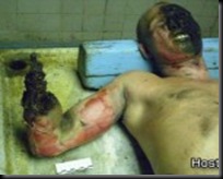 painful-electrical-burns-03-150x150