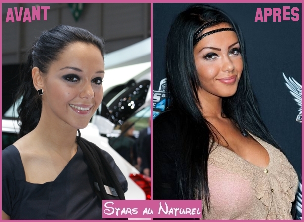 Nabilla chirurgie