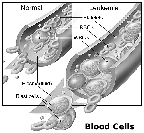 simptom leukemia dewasa Leukemia obliviate yg eimi