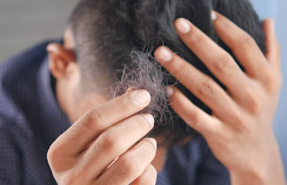 Vitamin untuk Mengatasi Rambut Rontok Paling Ampuh