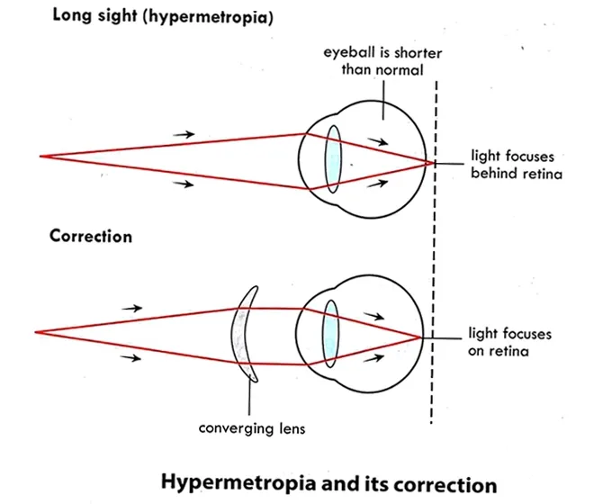 Long sight (hypermetropia) eye defect