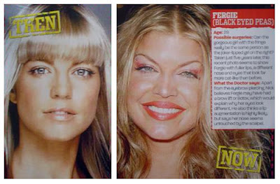 Fergie Plastic Surgery