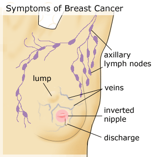 Sunbathing Reduces Risk of Breast Cancer