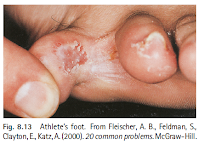 Athlete's Foot (Tinea Pedis)