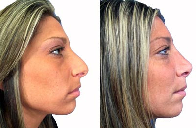 Nose Job Before After