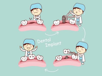 best dental implants in Bangalore