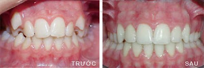 Tư vấn về vấn đề niềng răng khểnh