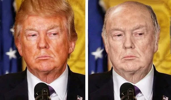 What kind of plastic surgery did Donald Trump have?